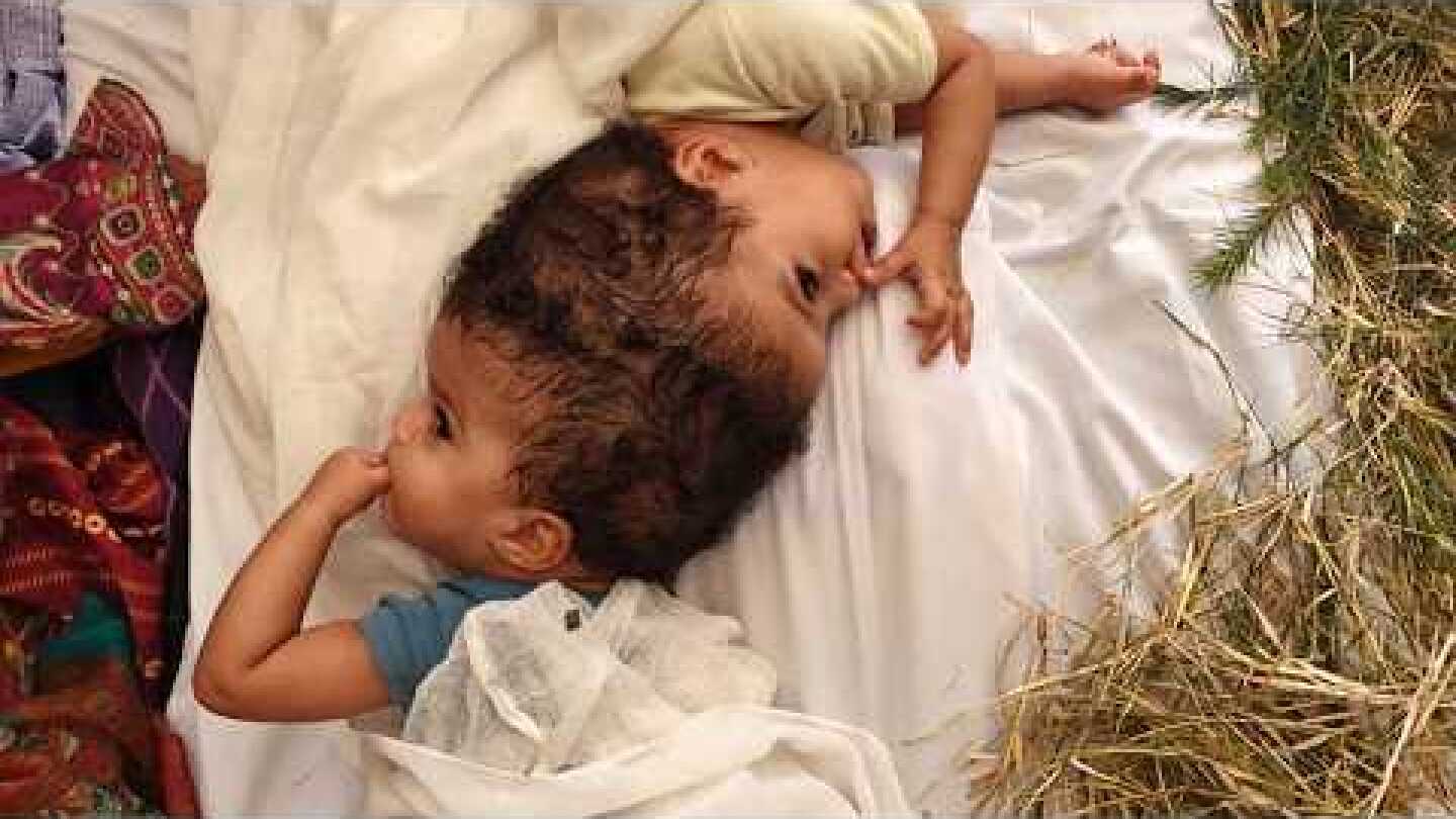 Rare Conjoined Twins Successfully Separated at SSM Health Cardinal Glennon Children's Hospital