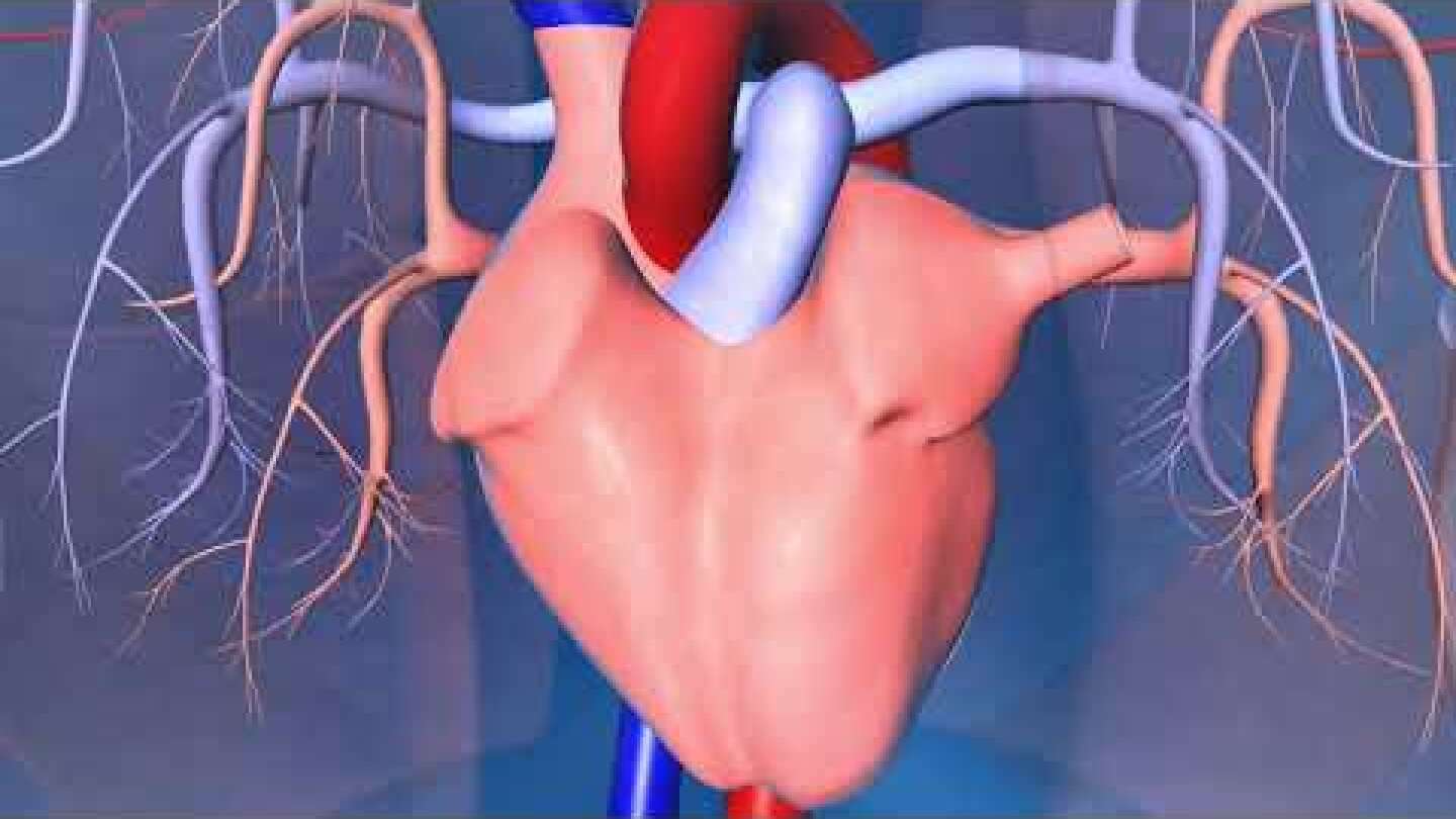 Implantable Cardioverter-Defibrillator (ICD)