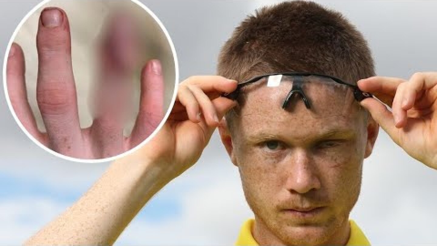 Australian hockey Matt Dawson player amputates finger to save Olympic dream