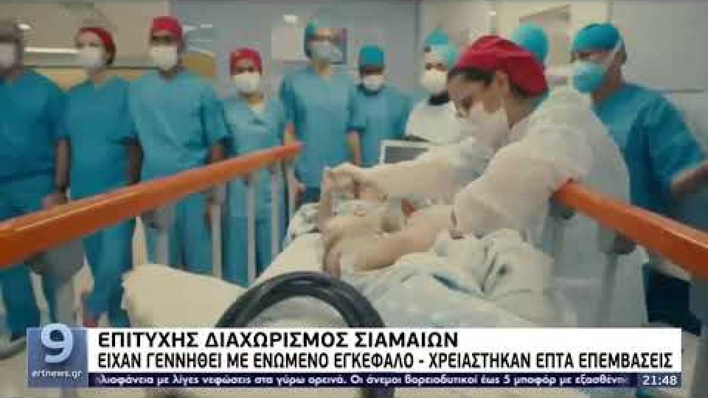 Επιτυχής διαχωρισμός σιαμαίων: Είχαν γεννηθεί με ενωμένο εγκέφαλο | 1/8/2022 | ΕΡΤ