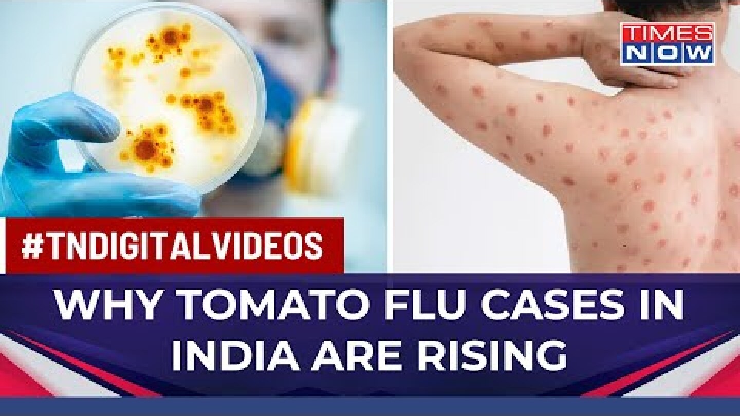 India Records Over 80 Cases Of Tomato Flu: Symptoms, Diagnosis, Cure | Health News | English News