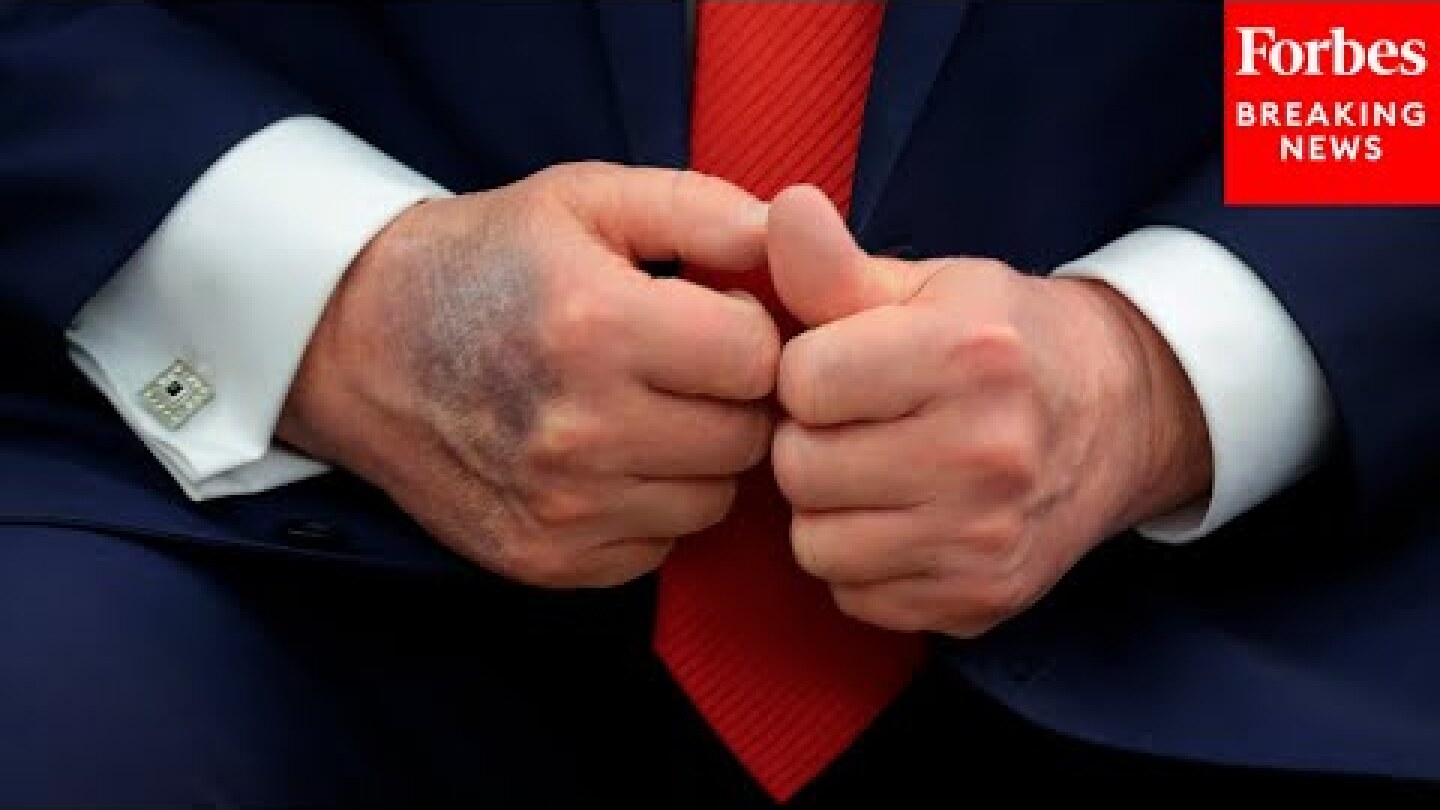 Trump Seen With Bruised Right Hand Again—Here’s Everything We Know About The Condition