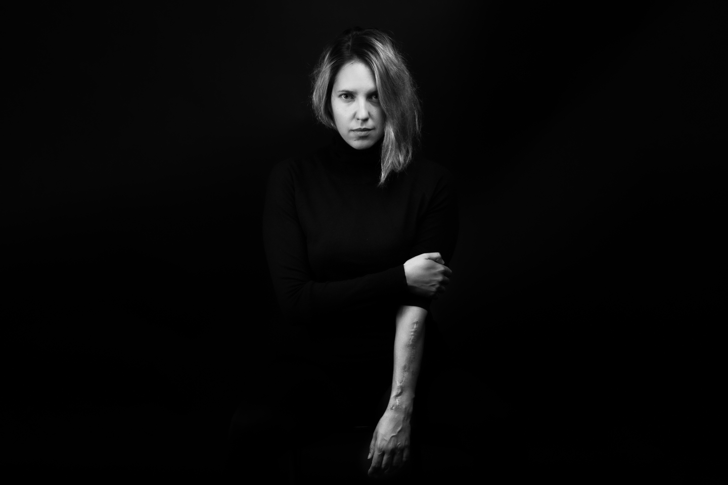 Ουλή από τριπλό συντριπτικό κάταγμα