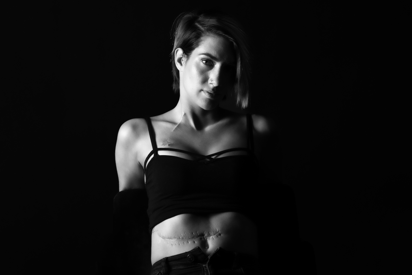 Ουλή από ειλεό