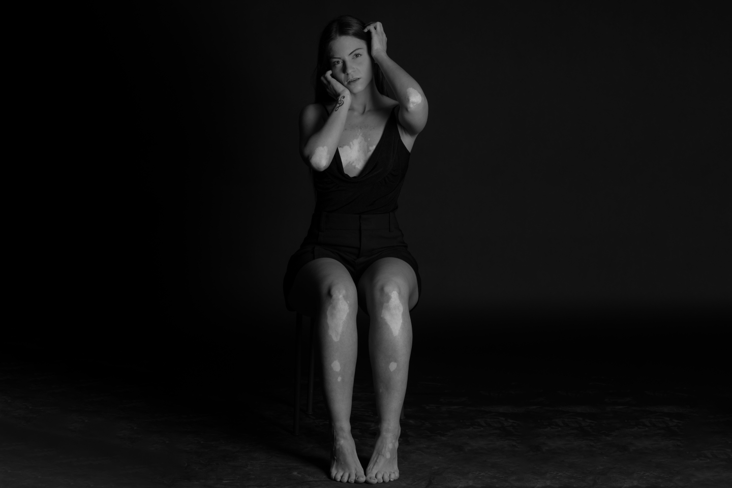 Σημάδια λεύκης