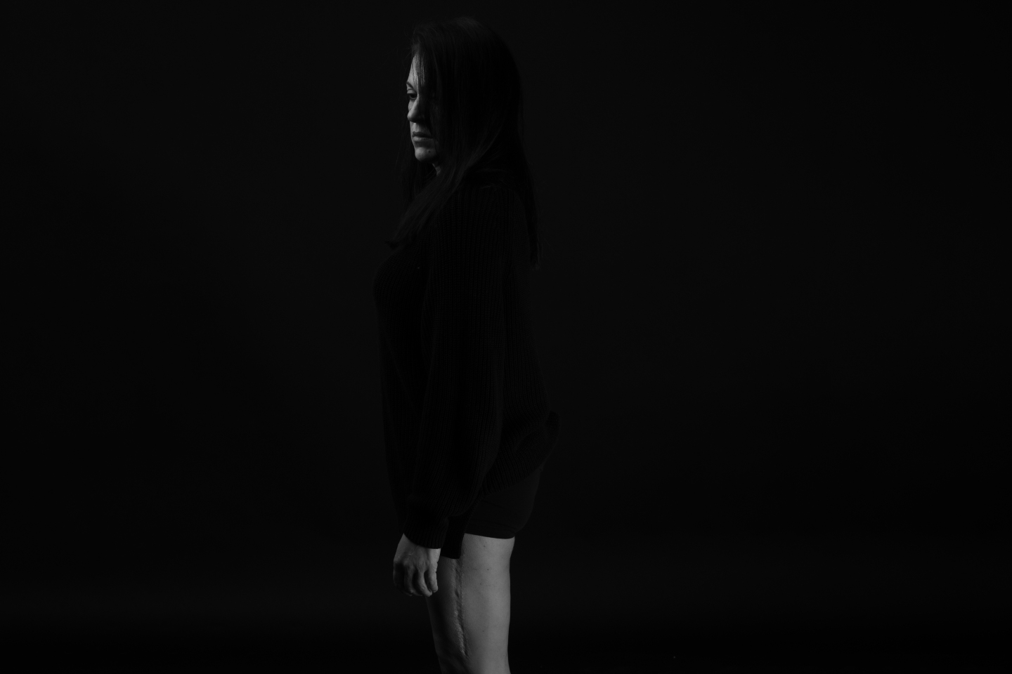 Ουλή από συντριπτικό κάταγμα