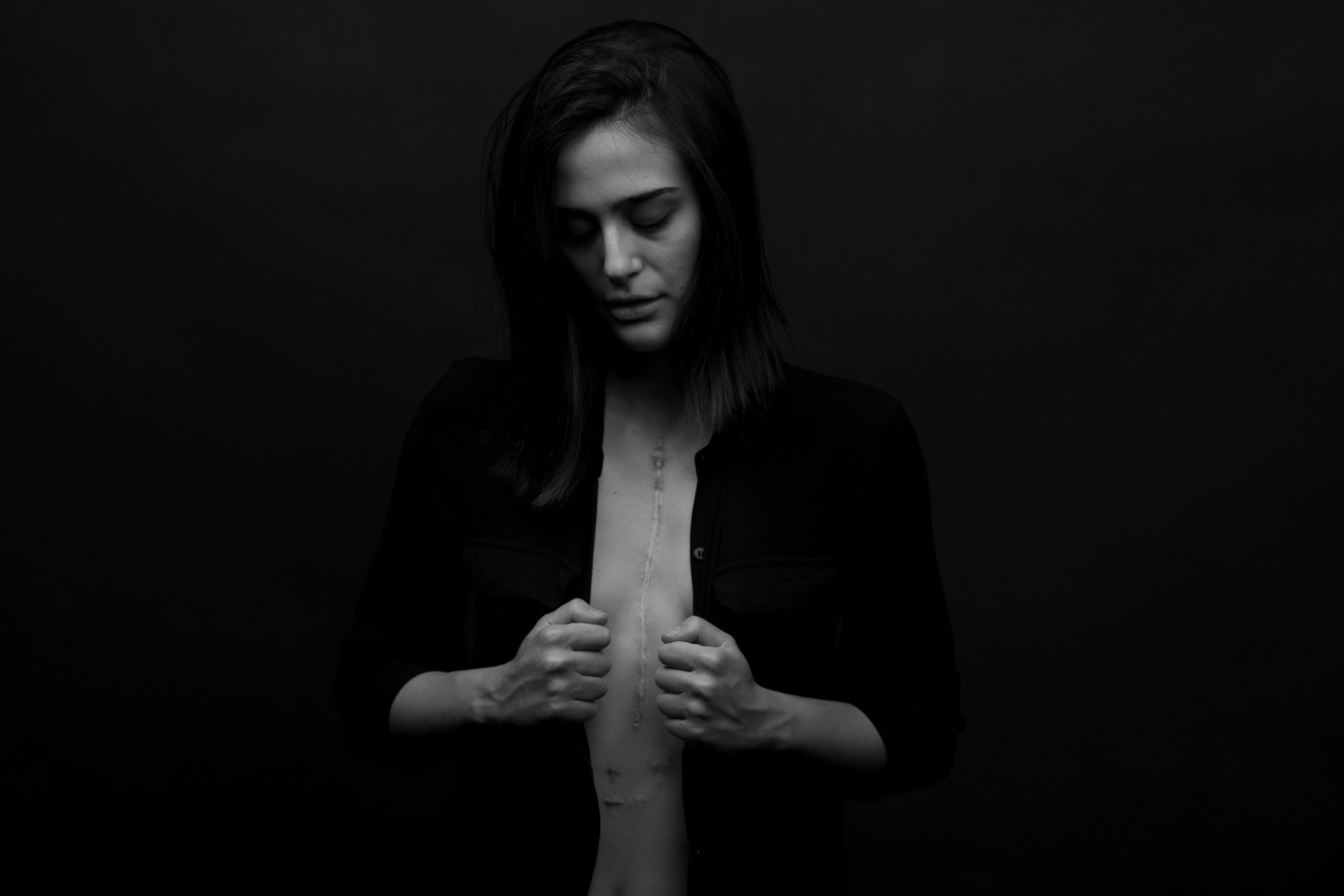 Ουλή από χειρουργείο ανοιχτής καρδιάς