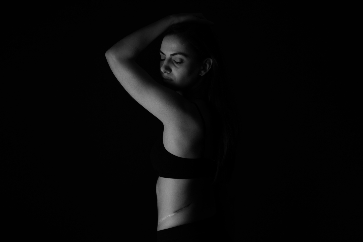 Ουλή από υδρονέφρωσ