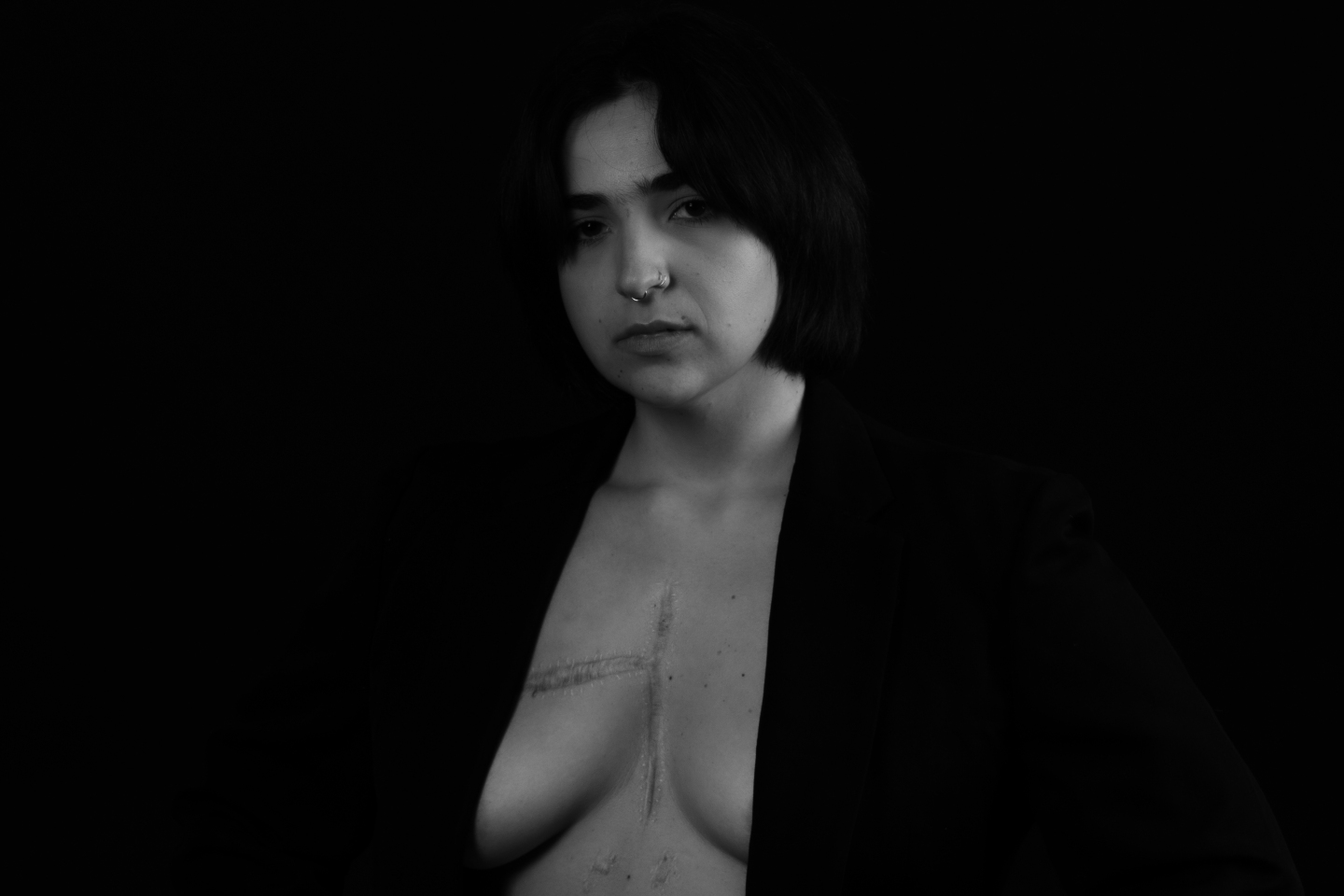 Ουλή από αφαίρεση όγκου