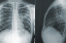 Μαγιορκίνης: Ραγδαία αύξηση της «Λευκής Πνευμονίας» - Πιθανότατα να έχει περιστατικά και στην Ελλάδα 