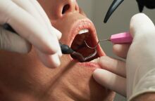 ΗΠΑ: Γυναίκα μηνύει οδοντίατρο για 4 απονευρώσεις, 8 θήκες και 20 σφραγίσματα σε ένα ραντεβού