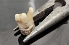 Βρετανία: Πολίτες αναγκάζονται να βγάζουν μόνοι τους τα δόντια τους