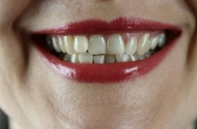 Κίτρινα δόντια: τα δύο λάθη που καταστρέφουν το χαμόγελό σας