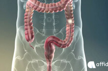 Καρκίνος Παχέος Εντέρου: Γιατί η κολονοσκόπηση είναι το κλειδί της πρόληψης