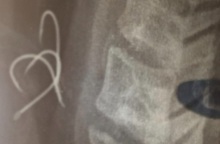 Αγρίνιο: 38χρονος έφαγε χταπόδι με αγκίστρι - Διακομίστηκε στην Αθήνα