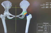 Νεότερες εξελίξεις στην αρθροπλαστική ισχίου