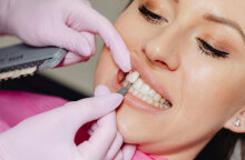 Όψεις πορσελάνης