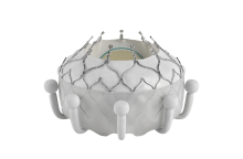 ΥΓΕΙΑ: Οι πρώτες στην Ελλάδα διαδερμικές εμφυτεύσεις ορθοτοπικής τριγλώχινας βαλβίδας 