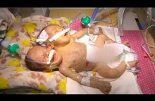 Conjoined twins in Yemen need international support to survive