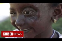 Yemen conflict: Six-year-old Yusra’s new eye - BBC News