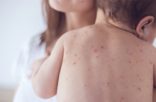 measles-preview.jpg