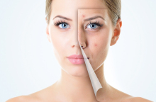 women-acne.jpg