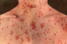 measles_1.jpg