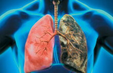 Καρκίνος του πνεύμονα