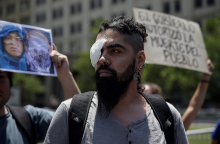 Διαδηλωτές με οφθαλμικά τραύματα στη Χιλή 