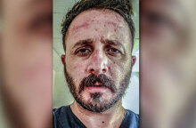 Κορωνοϊός: Ο ακτινολόγος στο ΠΑΓΝΗ Ευθύμης Φασουλάκης δείχνει τα σημάδια στο πρόσωπό του από την πολύωρη χρήση της μάσκας