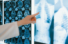 Ακτινογραφίες πνευμόνων