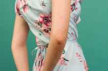 Ψωρίαση: Ποιες τροφές πρέπει να αποφεύγετε