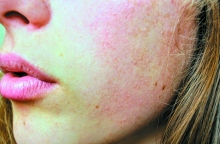 Πρόσωπο με σημάδια από ακμή