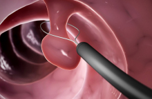 Καρκίνος παχέος εντέρου: Αποτελεσματική πρόληψη με κολονοσκόπηση