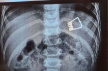 Ακτινογραφία με το μανταλάκι που κατάπιε το παιδάκι στη Λήμνο