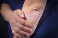 Ψωρίαση: 10 δεδομένα που πρέπει να γνωρίζουμε 