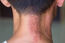 Στρες και έρπητας ζωστήρας: Υπάρχει σύνδεση; 