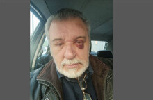 Ο Τάσος Χαλκιάς με μελανιασμένο μάτι μετά το ατύχημα