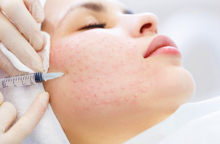 Προσφέρει όσα υπόσχεται η μεσοθεραπεία;