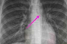 Θεσσαλονίκη: Ανήλικη κατάπιε καρφίτσα – Σωτήρια η επέμβαση των γιατρών στο Ιπποκράτειο Νοσοκομείο