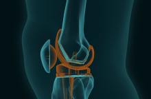 Aρθροπλαστική γόνατος και ισχίου: Τι ισχύει;