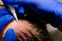 μεταμόσχευση μαλλιών, γυναικεία τριχόπτωση