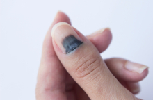 Μελανιά στο νύχι: Γιατί χρειάζεται άμεση ιατρική φροντίδα 