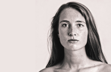 ασθενης με Νόσο του Χασιμότο