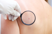 Μελάνωμα: Νεότερα δεδομένα δείχνουν αύξηση στους νέους 