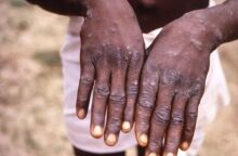 Ευλογιά των πιθήκων