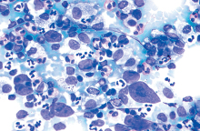 μη-Hodgkin λέμφωμα (ΜΗΛ)