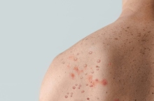 Νέα επιδημία mpox: Θα κάνουμε τα ίδια λάθη;   