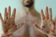 Ευλογιά των Πιθήκων: Ο ΠΟΥ ξεκαθαρίζει πως η mpox δεν είναι η νέα covid