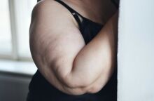 Η παχυσαρκία στην ηλικία 35-65 ετών αυξάνει τον κίνδυνο εμφάνισης άνοιας κατά περίπου 30%